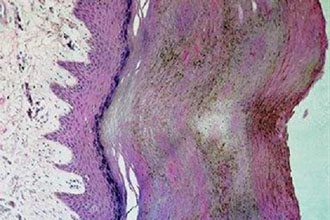 Στοπ στις κλινικές δοκιμές του «εμβολίου για τον καρκίνο του μαστού»