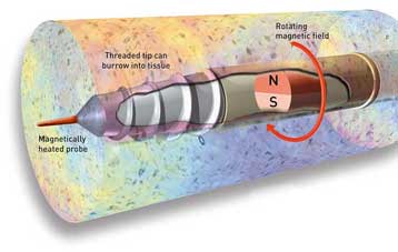 Μικρορομπότ εισέρχονται στην κυκλοφορία του αίματος και καταστρέφουν όγκους