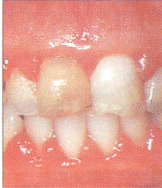 Ολοκληρώθηκε η χαρτογράφηση του μικροβίου DNA που ευθύνεται για τις στοματικές λοιμώξεις