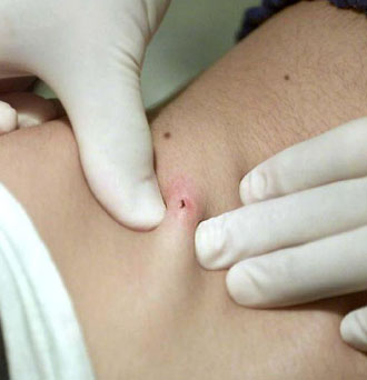 Κρούσματα αιμορραγικού πυρετού στο Κόσοβο