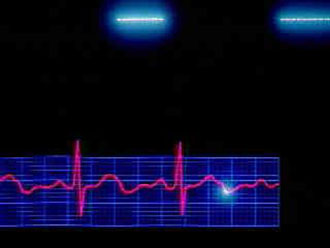 ΠΟΥ: Σύστημα παρακολούθησης για μείωση των κρουσμάτων εγκεφαλικού