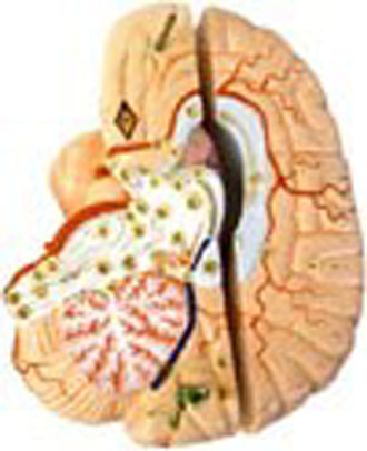 Ιός προσφέρει θεραπεία σε εγκεφαλικούς όγκους