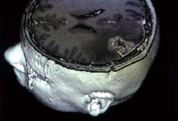 Η ανεμοβλογιά προστατεύει από τη δημιουργία όγκων στον εγκέφαλο