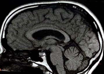 Έρευνα συνδέει το τραύλισμα με δομικές ανωμαλίες του εγκεφάλου