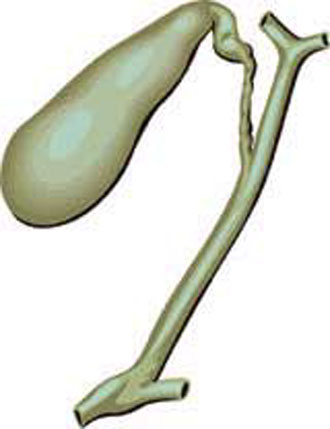 Η άθληση προστατεύει τους υπέρβαρους από χολολιθίαση