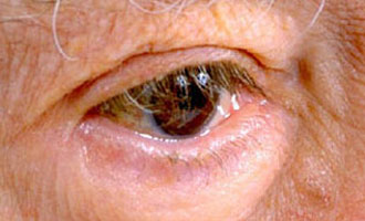 Έλληνες ερευνητές ανακάλυψαν θεραπεία για τη νόσο «Aδαμαντιάδη»