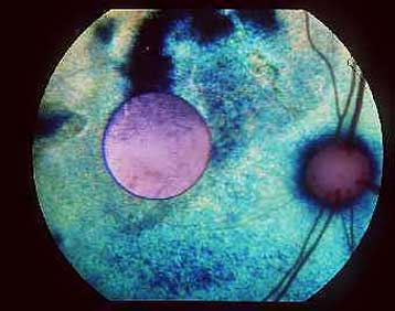 Τεχνητοί αμφιβληστροειδείς εμφυτεύονται σε ασθενείς με περιορισμένη όραση