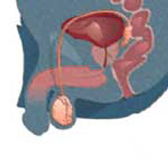 Μικροτσίπ ανιχνεύει εγκαίρως τον καρκίνο του προστάτη