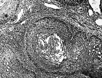 Ιός οδηγεί τα καρκινικά κύτταρα σε αυτοκτονία