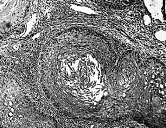Το ανοσοποιητικό σύστημα υπεύθυνο για τον καρκίνο;