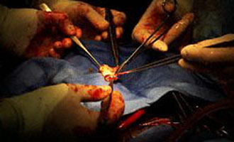 Ανησυχία για τους ασθενείς που έχουν υποβληθεί σε αντικατάσταση βαλβίδας