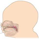 Ανακαλύφθηκε το γονίδιο για το λυκόστομα