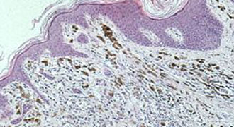 Επικίνδυνα για μελάνωμα τα εγκαύματα κατά την παιδική ηλικία