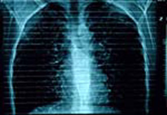 To άσθμα «οφείλεται περισσότερο στα γονίδια παρά στο περιβάλλον»