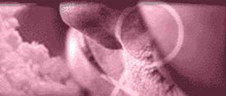 Το χαμηλό βάρος κλειδί για τη θεραπεία των πολυκυστικών ωοθηκών