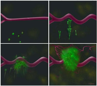 Έξι χιλιάδες νέα κρούσματα καρκίνου του παχέος εντέρου ετησίως στην Ελλάδα