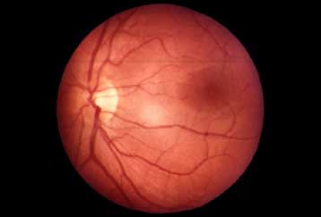 Θεραπεία της τύφλωσης με γενετική μηχανική;