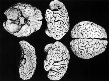 Δομικές ιδιομορφίες παρουσίαζε ο εγκέφαλος του Αϊνστάιν