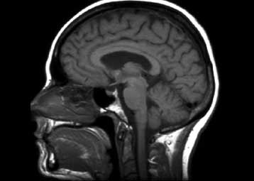 Οι εκ γενετής κωφοί πράγματι απολαμβάνουν τη μουσική