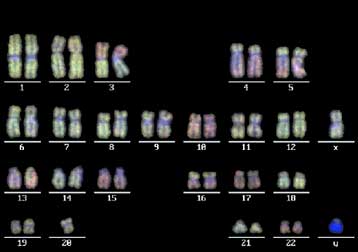 Aνακαλύφθηκε καινούρια μορφή λευχαιμίας