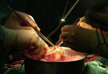 Eπιτυχής η πρώτη μεταμόσχευση ολόκληρων κατεψυγμένων οργάνων