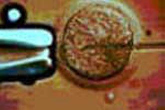 The Lancet: Κίνδυνος νευρολογικών επιπλοκών σε νεογνά εξωσωματικής γονιμοποίησης