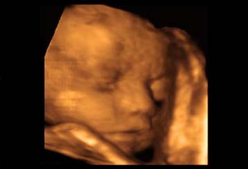 Ανησυχητική αύξηση των συγγενών ανωμαλιών επισημαίνουν Βρετανοί επιστήμονες