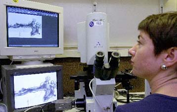 Το αντισυλληπτικό χάπι αυξάνει τον κίνδυνο ανάπτυξης καρκίνου του μαστού