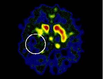 Πειραματική θεραπεία μειώνει κατά 80% τα συμπτώματα της νόσου του Πάρκινσον