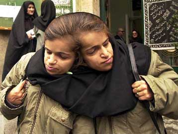 Έφτασε η ώρα να «χωρίσουν» δύο ενήλικες σιαμαίες αδελφές από το Ιράν