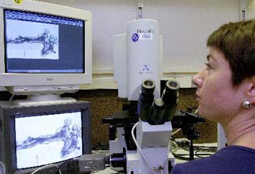 Εντοπίστηκε γονίδιο που αυξάνει τις πιθανότητες εμφάνισης καρκίνου του μαστού