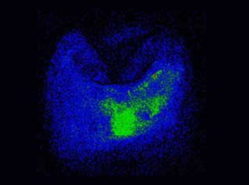 Κινητό τηλέφωνο που εμφυτεύεται σε ανθρώπινο δόντι επινόησαν Βρετανοί μηχανικοί