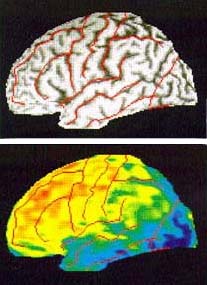 Ο υγιεινός τρόπος ζωής ασπίδα προστασίας από τη νόσο Αλτσχάιμερ