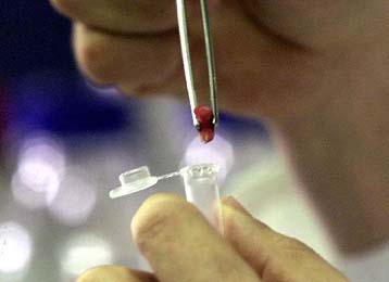 Βρετανοί επιστήμονες εκτιμούν ότι η επιδημία της νόσου Κρόιτσφελντ-Γιάκομπ συνεχίζεται