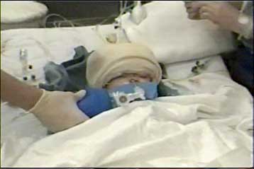 Συγκρατημένη αισιοδοξία για τα σιαμαία από τη Γουατεμάλα που χωρίστηκαν χειρουργικά