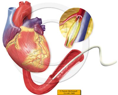 Η λήψη συμπληρωμάτων συμπλέγματος βιταμίνης Β ελαττώνει τον κίνδυνο επαναστένωσης των αγγείων