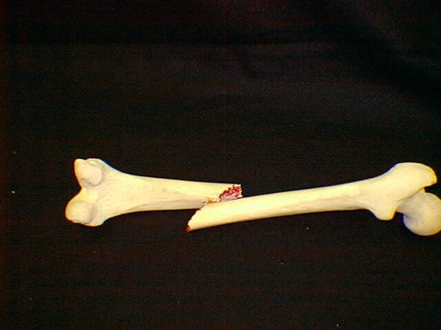 Η νευρογενής ανορεξία αυξάνει σημαντικά τον κίνδυνο καταγμάτων για μεγάλο χρονικό διάστημα