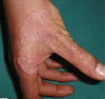 Νέα στοιχεία για τη θεραπεία των δερματικών λοιμώξεων