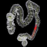 Απαραίτητη η κολονοσκόπηση και για τις γυναίκες άνω των 50 ετών