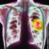 Καρκίνος του πνεύμονα: η αποτυχία της πρόληψης
