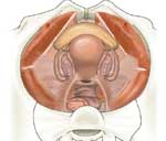 Αυξητική τάση παρουσιάζει ο καρκίνος του ενδομητρίου