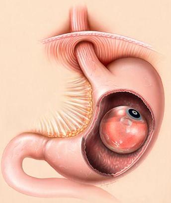 Ένα «μπαλόνι»… για αδυνάτισμα