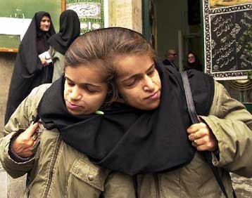 Έτοιμες για την επέμβαση διαχωρισμού τους δύο Ιρανές δίδυμες ενωμένες στο κεφάλι