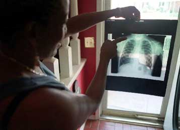 Έρευνες προσφέρουν ελπίδα για την αντιμετώπιση του καρκίνου του πνεύμονα