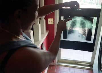 Φορητός σαρωτής εντοπίζει καρκινικούς όγκους με ένα πέρασμα πάνω από τον ασθενή