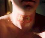 Οι επεμβάσεις στο στομάχι προδιαθέτουν για καρκίνο του λάρυγγα