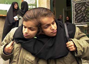 Αρχισε στη Σιγκαπούρη ο χειρουργικός διαχωρισμός 29χρονων σιαμαίων από το Ιράν