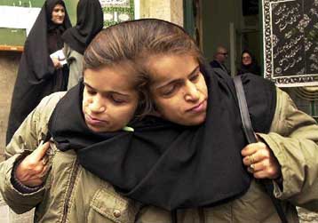 Σε κρίσιμη κατάσταση οι Ιρανές αδελφές μετά την ολοκλήρωση της επέμβασης διαχωρισμού