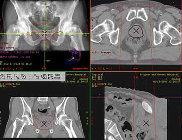 Ο αυνανισμός προστατεύει από τον καρκίνο του προστάτη
