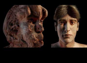 Γενετιστές αναλύουν το DNA του Ανθρώπου Ελέφαντα